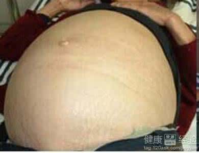 中医治疗肝腹水 肝腹水治疗 中医治疗肝腹水效果好