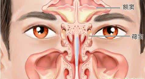 鼻窦炎的症状及治疗 鼻窦炎的症状、病因及治疗
