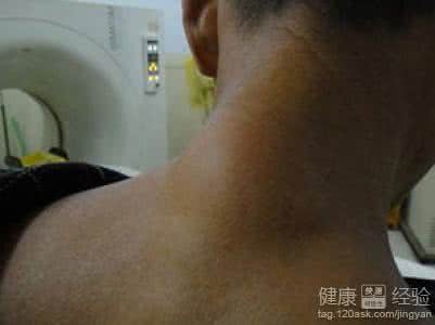 脂肪瘤会痛吗 脂肪瘤会痛吗 脂肪瘤痛了，发紫了怎么办？