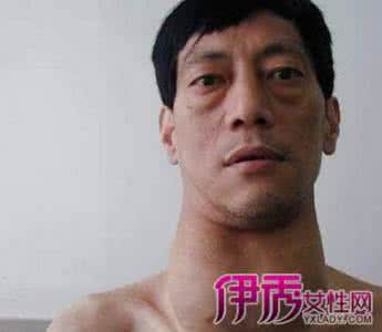大脖子病症状 大脖子病症状 大脖子病有哪些症状 脖子有肿块时一定要注意