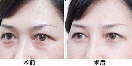 眼袋怎么消除按摩法 眼袋怎么消除