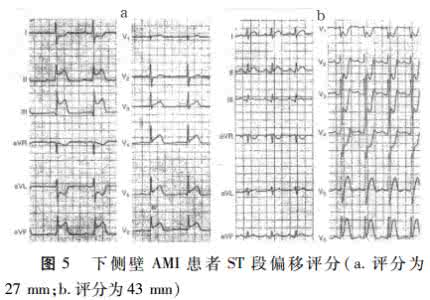 罪犯血管 STEMI相关罪犯血管的体表心电图判断