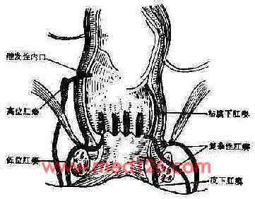 肛门瘘管 肛门瘘管 肛门瘘管 它的临床表现是什么