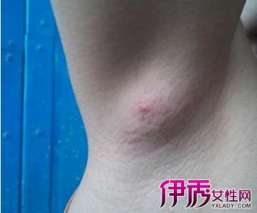 肠系膜淋巴结炎的症状 淋巴结炎症状 淋巴结炎的九大饮食疗法