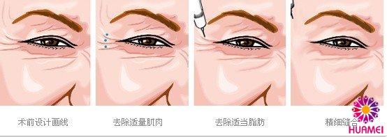 生物素注射除皱 生物素除皱 生物素注射除皱