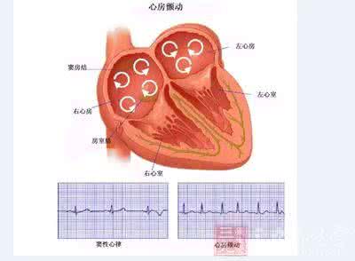 房颤伴室内差异性传导 房颤治疗存在种族与性别差异