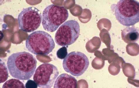 淋巴细胞白血病的症状 白血病的症状 慢性淋巴细胞白血病的症状