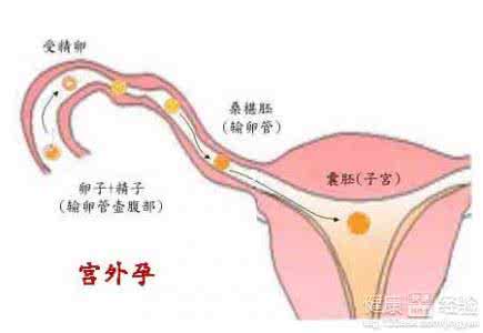 预防宫外孕最好的办法 预防宫外孕最好的办法 慎防宫外孕“二次进攻”