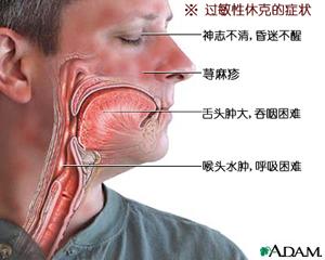 过敏性休克 过敏性休克都有哪些临床症状呢