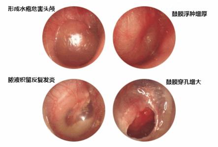 儿童中耳炎症状与治疗 儿童中耳炎症状 儿童中耳炎症状 诱发中耳炎的因素有哪些