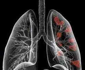 肺癌晚期中药偏方 肺癌晚期中药偏方(转）