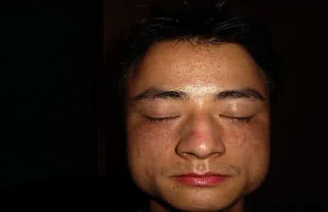 白附子 白附子治雀斑方