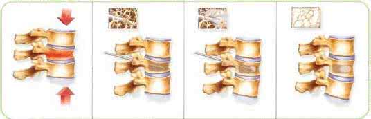腰椎骨质增生症治疗 腰椎骨质增生 皮内针治疗腰椎骨质增生症