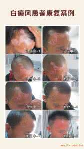 微量元素缺乏的症状 缺乏微量元素吃什么 人体缺乏什么元素会得白癜风