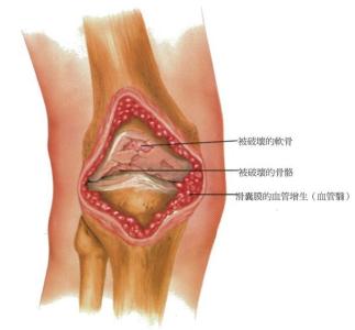 膝盖风湿性关节炎症状 膝盖风湿性关节炎的症状