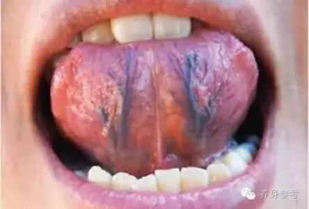 舌下血管发紫 舌下长紫筋，血管有危险！一个小偏方却能改善这种情况！