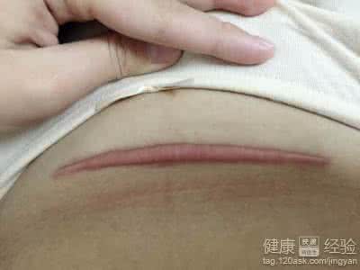 剖腹产疤痕增生前兆 剖腹产疤痕增生症状