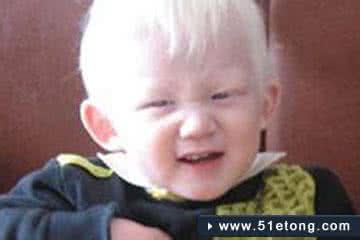 常见家族遗传病有哪些 遗传病有哪些?