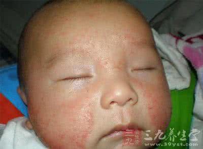 肛门湿疹的防治方法 宝宝湿疹怎么办 宝宝湿疹的防治的方法