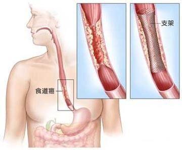 食道癌的形成需要几年 食道癌的治疗 食道癌治疗 这些要点你需知道