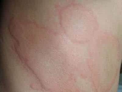 慢性荨麻疹的注意事项 慢性荨麻疹注意事项 治疗慢性荨麻疹的注意事项