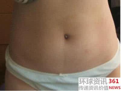剖腹产后疤痕增生 剖腹产疤痕增生怎么办 吴昕怀孕了?肚子上的疤痕被怀疑是剖腹产留下来的