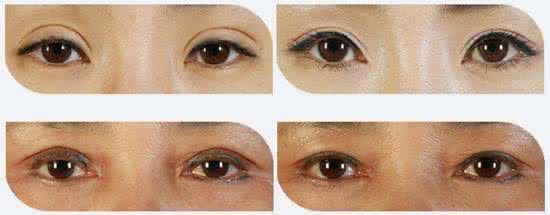重睑失败修复手术费用 重睑失败修复手术费用 重睑失败修复术