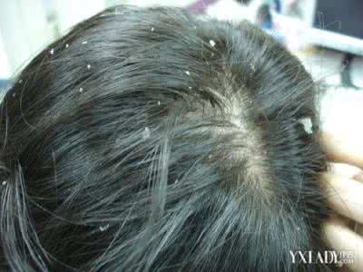 头皮屑多如何去除 头皮屑多如何去除 头皮屑如何去除
