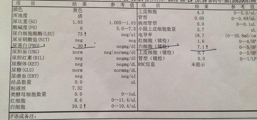 尿蛋白高治疗方法 尿蛋白的治疗方法 尿蛋白高怎么治疗 治疗尿蛋白高的方法