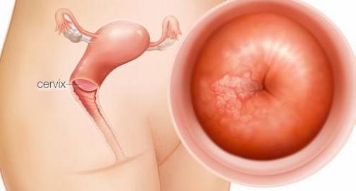 宫颈上皮内瘤变 宫颈上皮内瘤变 宫颈上皮内瘤变有哪些症状