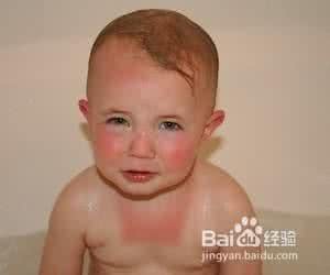 婴儿脸晒伤怎么办 宝宝晒伤了怎么办
