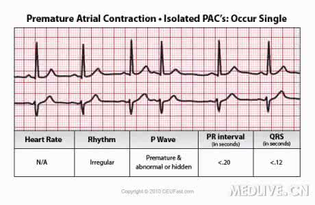 心律失常心电图 药物致心律失常的心电图特征