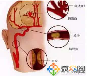 脑梗塞不能说话 脑梗塞圈 你敢说你没有脑梗吗？来，画个圈试试