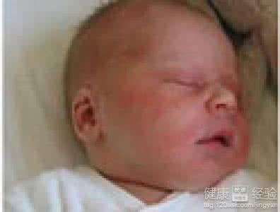婴儿湿疹的治疗方法 关于婴儿湿疹的治疗方法和注意事项