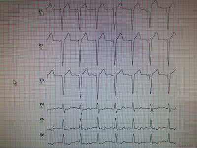 常见心电图诊断 心电图诊断中的常见词汇*