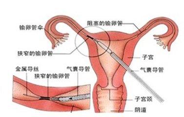 腹腔镜治疗输卵管粘连 腹腔镜治疗输卵管粘连 腹腔镜技术治疗输卵管粘连