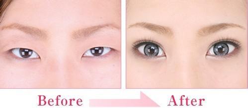 小眼睛割双眼皮 小眼睛割双眼皮 小眼睛,肿眼皮的人适合做什么样的双眼皮