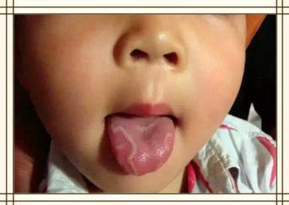 孩子地图舌怎么办 孩子的地图舌家长可以这样调理