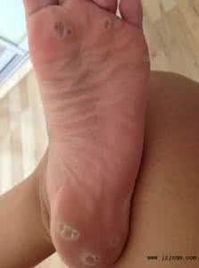 跖疣图片 跖疣怎么形成的