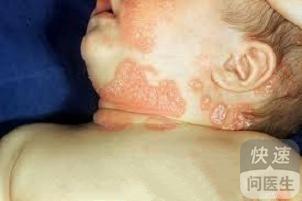 儿童鼻炎怎么治疗 儿童牛皮癣怎么治疗?