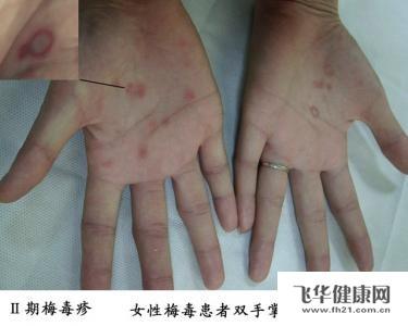 梅毒治疗方法 梅毒如何治疗方法 梅毒的最常见的治疗方法