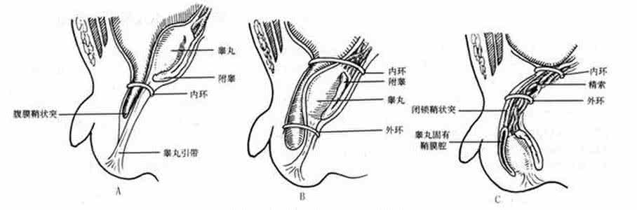 腹股沟疝发病率 腹股沟疝发病率 腹股沟疝的发病原因有哪些