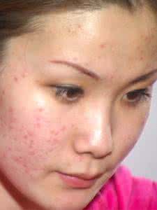 痤疮和痘痘有什么区别 痤疮 痘痘痤疮