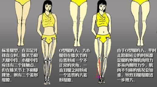 矫正o型腿最有效的动作 o型腿矫正方法