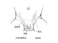 鞘状突未闭 鞘状突未闭什么意思？