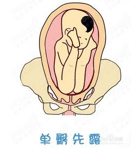 胎位不正会入盆吗 胎位不正能顺产吗
