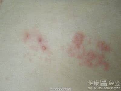 北京京仁医院 治疗带状疱疹的药物 北京京仁医院怎么样？疱疹治疗药物？