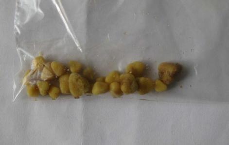 尿结石原因 尿结石 尿结石的原因 尿结石多数和这些因素有关