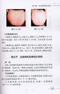 糖尿病中医辨证及用药 糖尿病舌诊辨证用药经验