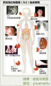 红斑狼疮临床表现 红斑狼疮的临床表现 干细胞移植治疗系统性红斑狼疮13项临床研究通过